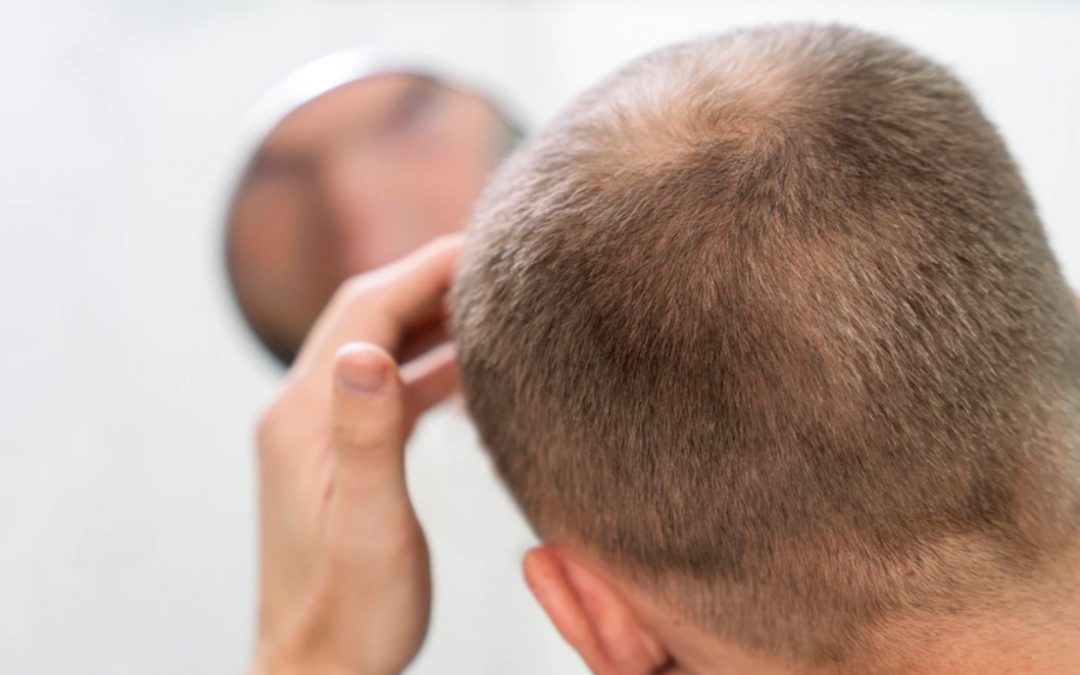 Calvície e queda de cabelos: cortes estratégicos valorizam os fios